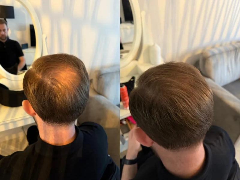 Alejandro S. Madrid before and after results